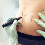 Эксперт: липосакция не поможет похудеть