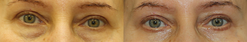 Александр Жуков блефаропластика