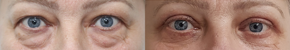 Пациентка доктора Жукова до и после блефаропластики