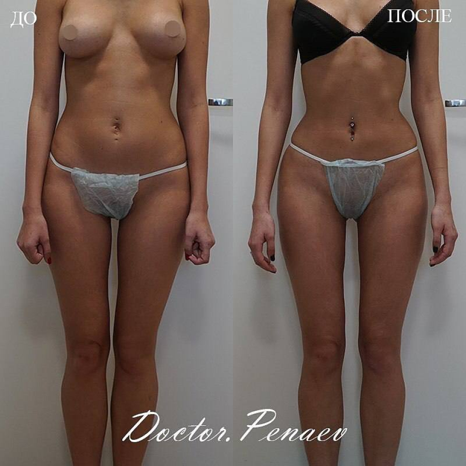 Пациентка (24 года) профессора Арслана Пенаева до и после операции  Бодидизайн (липосакция вазер)