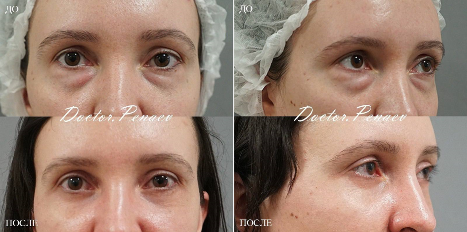 Пациентка (32 года) доктора Арслана Пенаева до и после блефаропластики