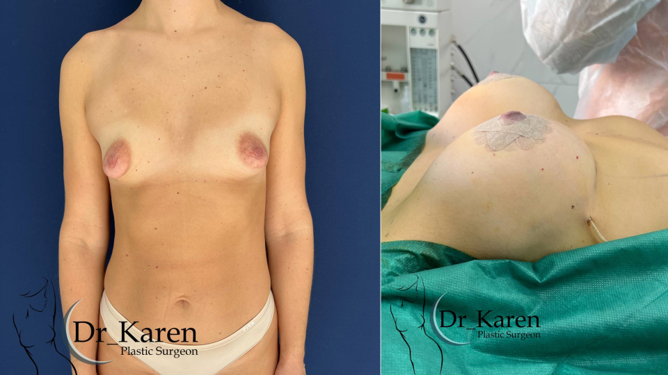 Пациентка пластического хирурга Карена Пайтяна до и после увеличения груди с коррекцией тубулярности