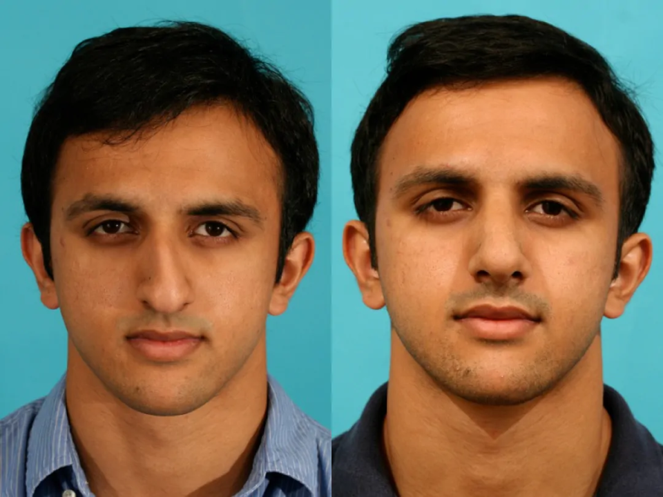 Пациент доктора Гукаса Миракяна до и после ринопластики