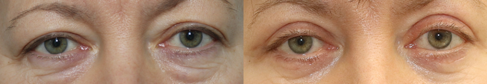 Александр Жуков блефаропластика