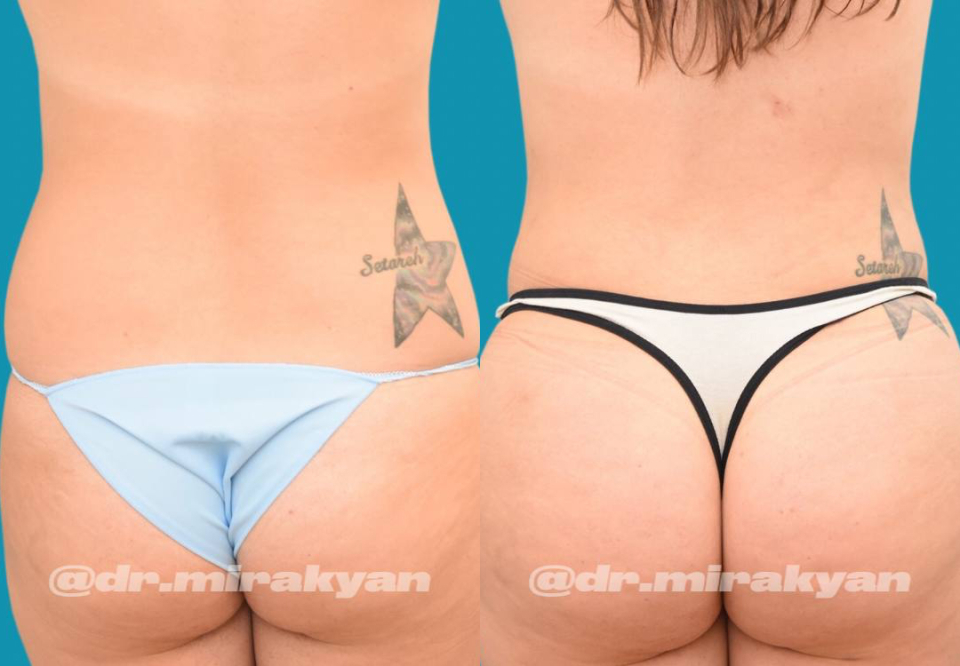 Пациентка доктора Гукаса Миракяна до и после липофилинга ягодиц