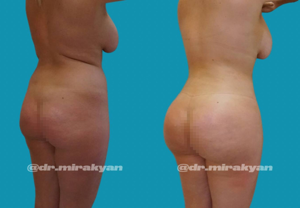 Гукас Миракян Липосакция до и после