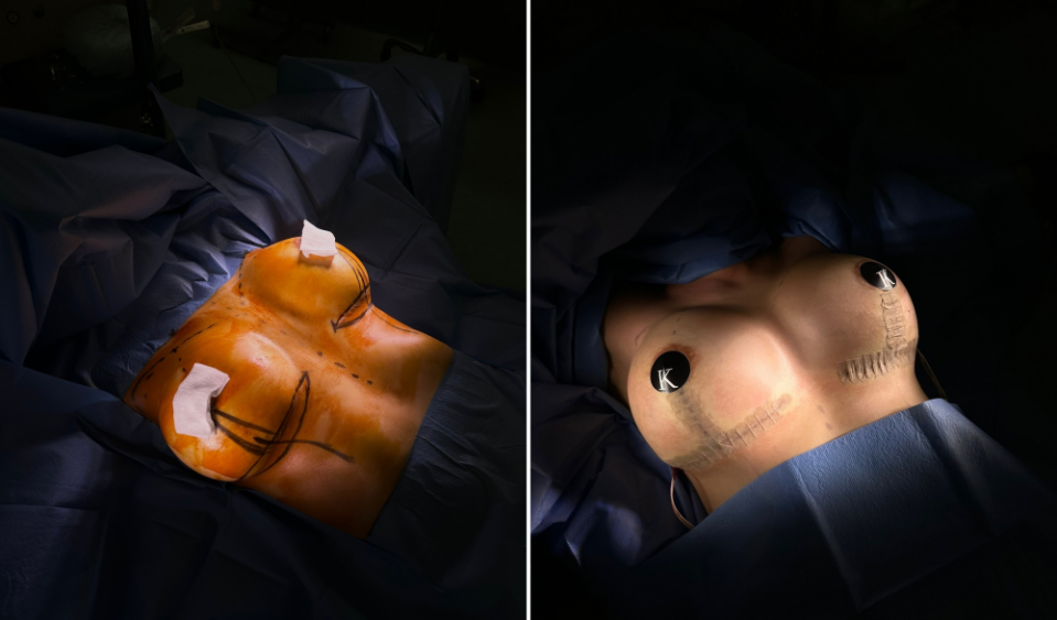 Пациентка пластического хирурга Карена Пайтяна. Результат реэндопротезирования.