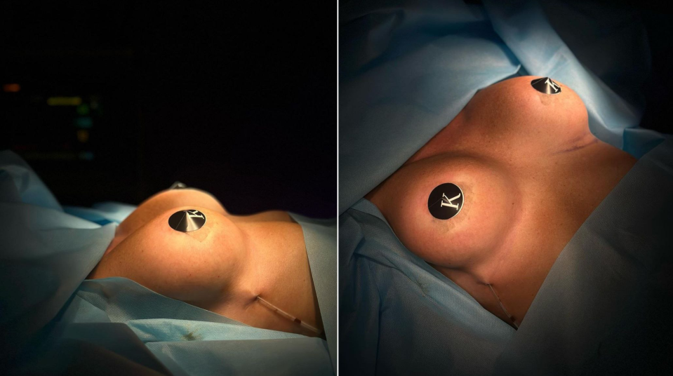 Пациентка пластического хирурга Карена Пайтяна. Фото после увеличения молочных желез через доступ по ареоле