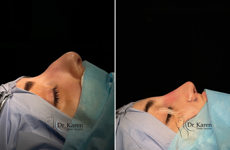Пациентка пластического хирурга Карена Пайтяна до и после ринопластики.
