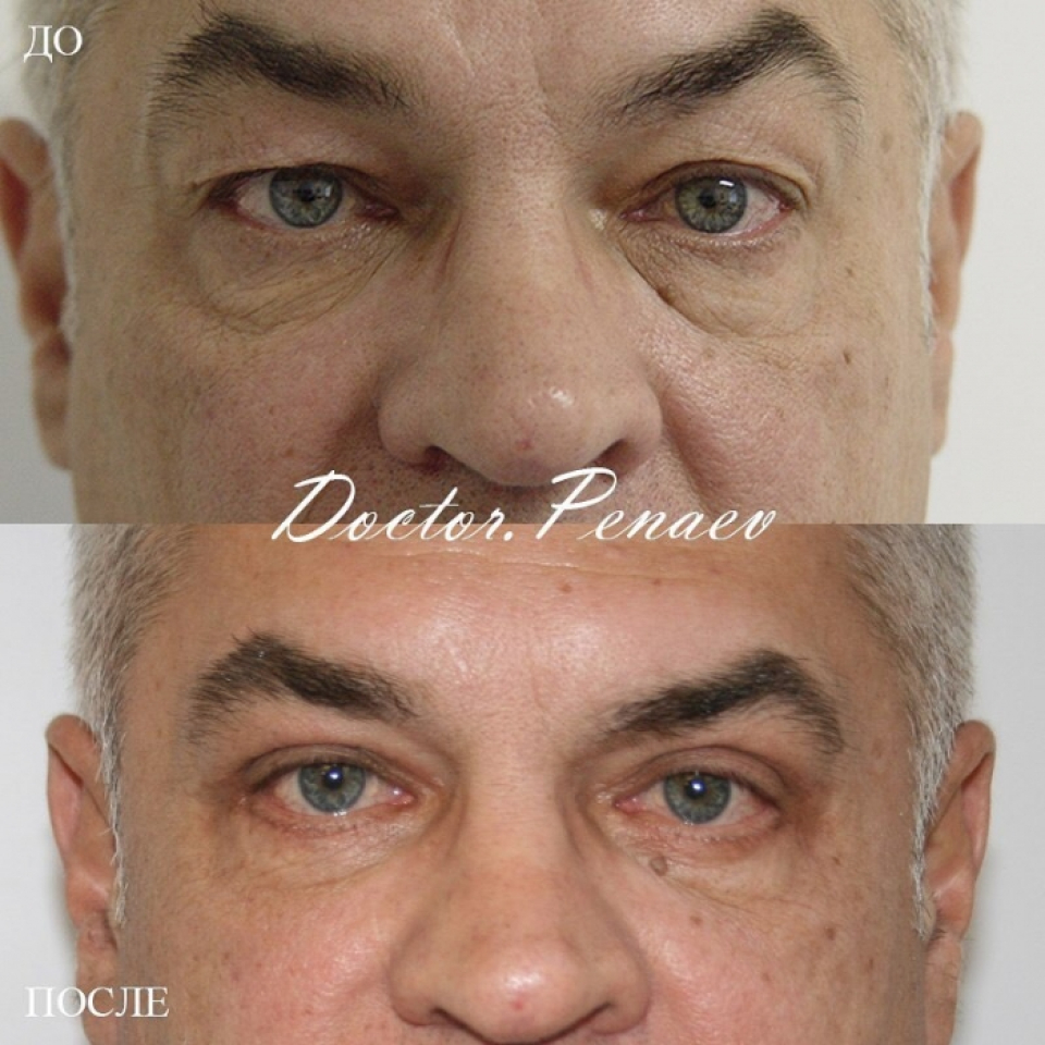 Блефаропластика для мужчин