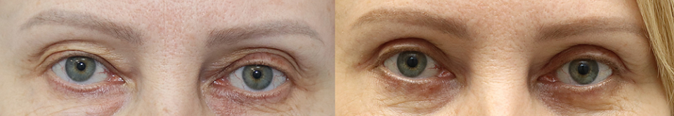 Пациентка доктора Александра Жукова до и после блефаропластики