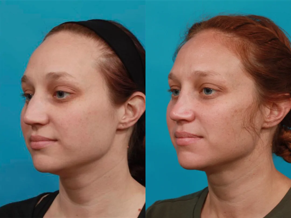 Пациентка пластического хирурга Гукаса Миракяна. Фото до и после ринопластики в Москве