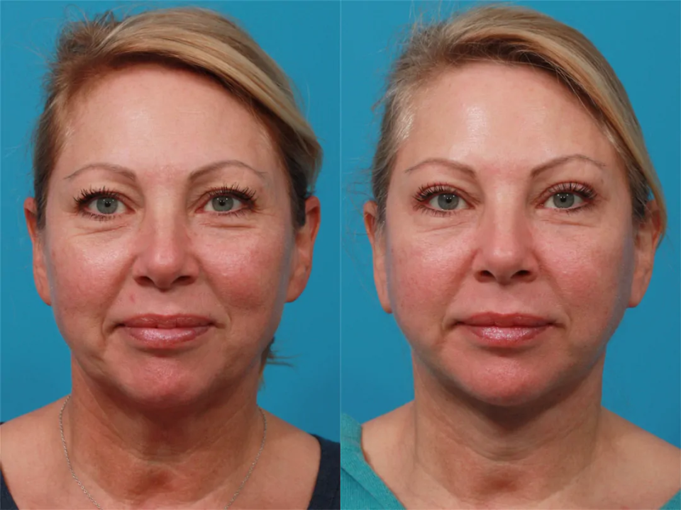Пациентка пластического хирурга Гукаса Миракяна. Фото до и после омолаживающей операции по подтяжке лица и шеи