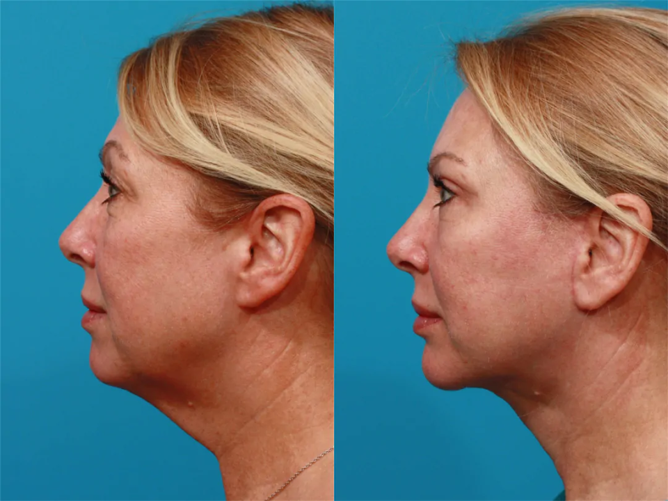 Пациентка пластического хирурга Гукаса Миракяна. Фото до и после омолаживающей операции по подтяжке лица