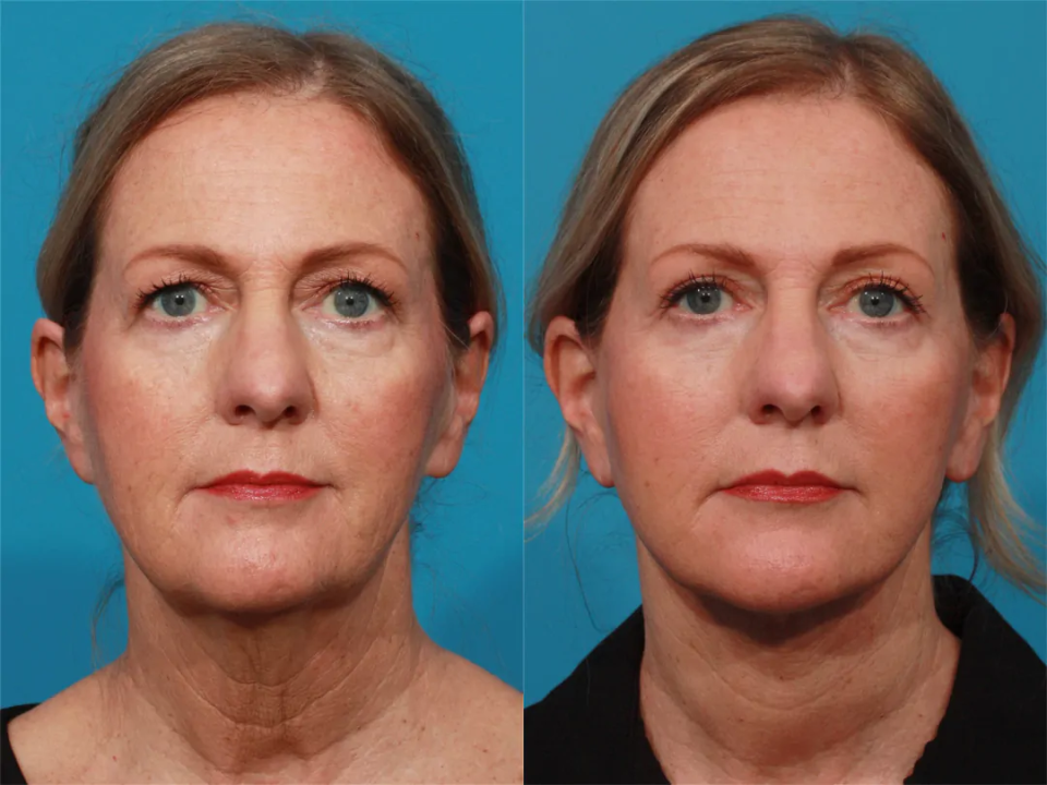 Пациентка пластического хирурга Гукаса Миракяна. Фото до и после операции по подтяжке лица