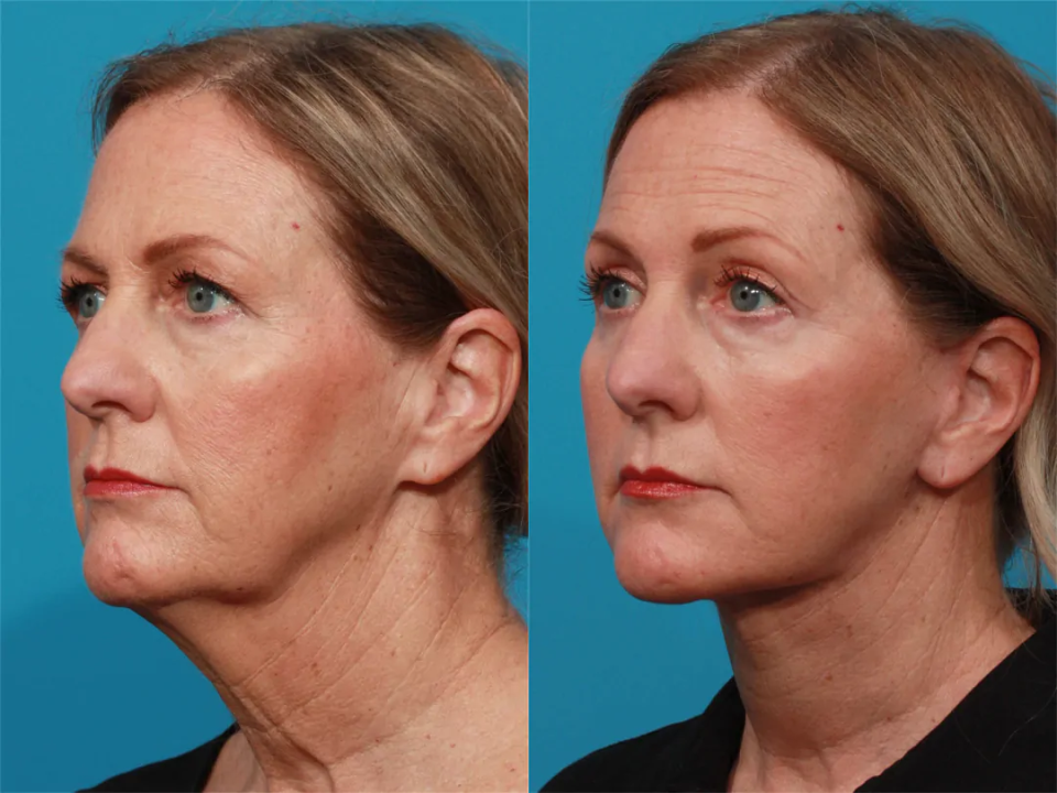 Пациентка хирурга Гукаса Миракяна. Фото до и после операции по подтяжке лица