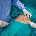 Ошибки, которых следует избегать после липосакции	