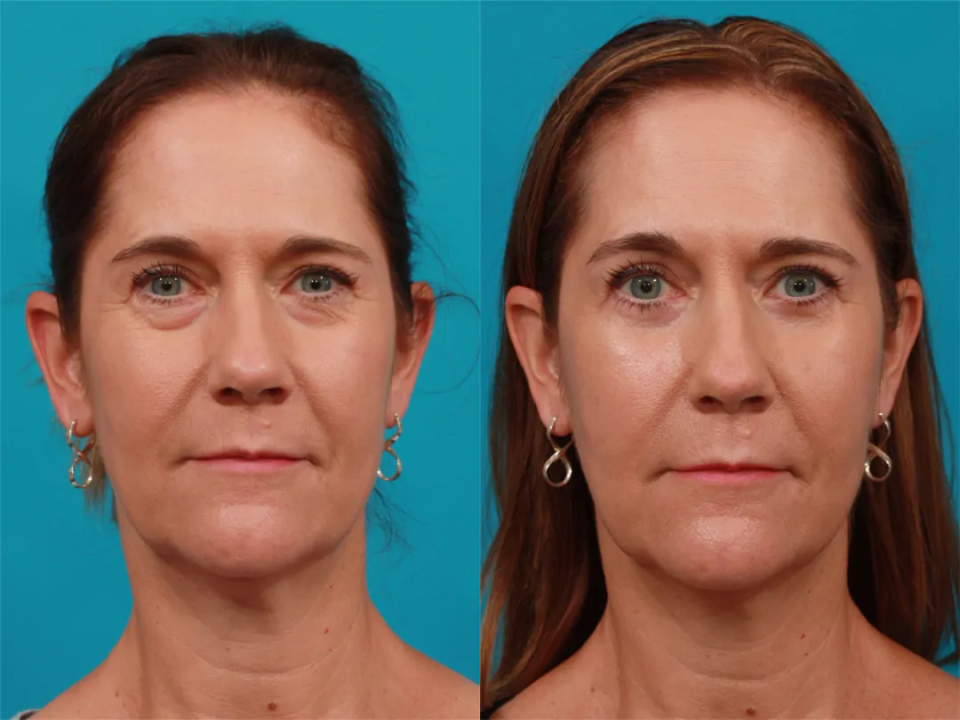 Пациентка пластического хирурга Гукаса Миракяна до и после блефаропластики