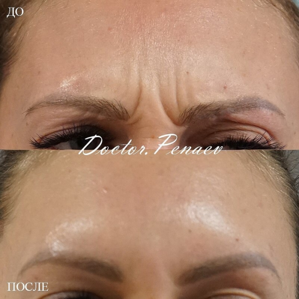 Пациентка доктора Арслана Пенаева до и после процедуры «Вечный ботокс»
