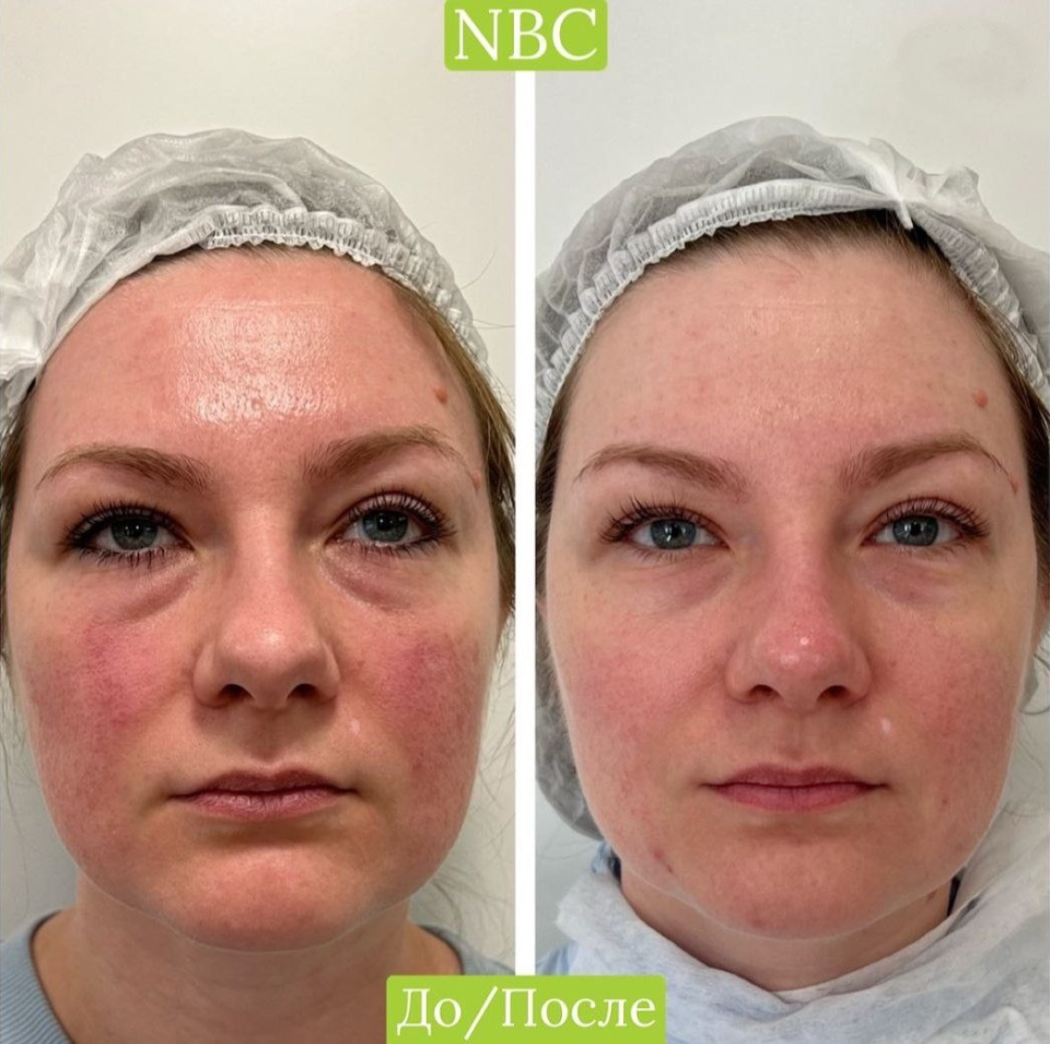 Пациентка клиники NBC до и после лечения розацеа