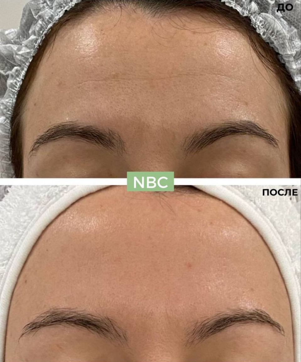 Пациентка клиники NBC. Пройден курс пилингов.