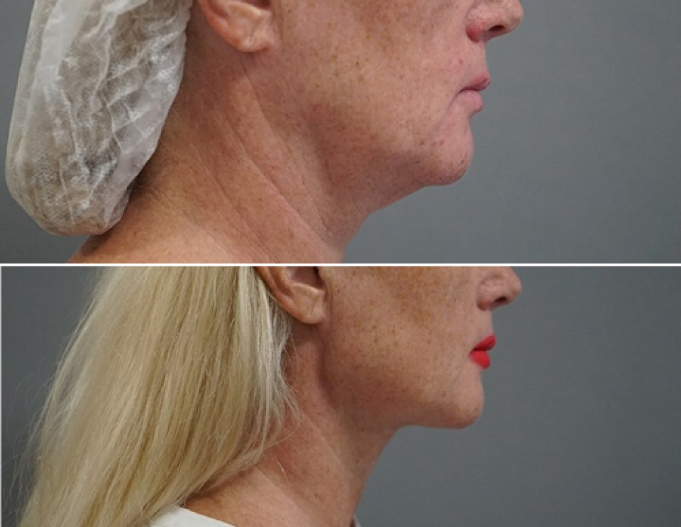 Пациентка (49 лет) доктора Пенаева до и после мльтитехнологичного лифтинга лица