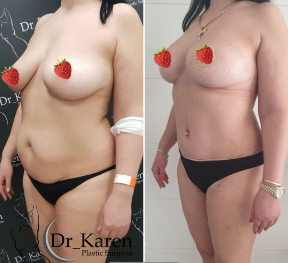 Пациентка пластического хирурга Карена Пайтяна. Фото до и после комплексного послеродового восстановления