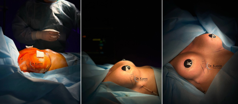 Пациентка пластического хирурга Карена Пайтяна до и после реэндопротезирования груди.