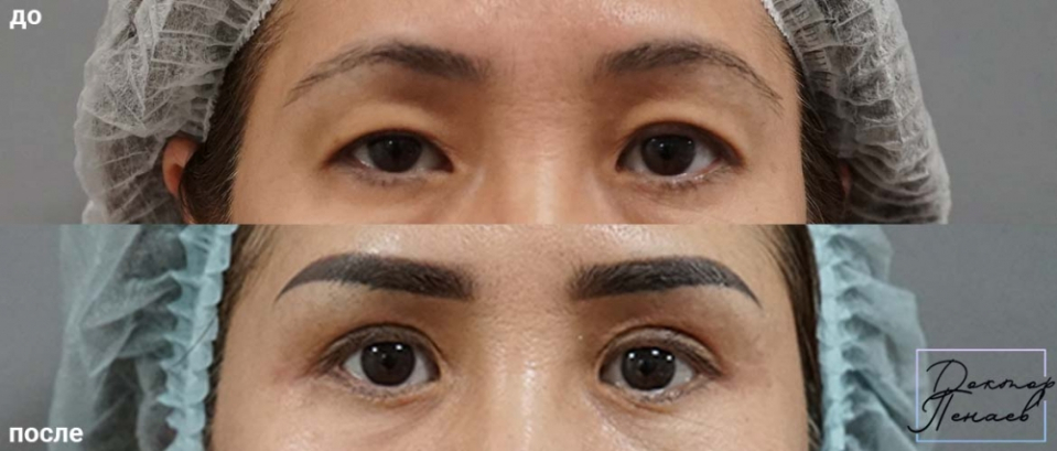 Пациентка пластического хирурга Арслана Пенаева до и после азиатской блефаропластики
