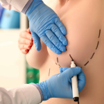 Этапы заживления разрезов после маммопластики