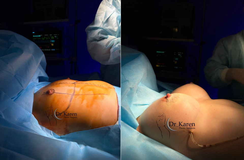 Пациентка доктора Карена Пайтяна. Результат увеличения груди сразу после операции.