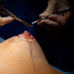 Новосибирские хирурги разработали новую технологию подтяжки груди