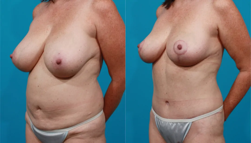 Пациентка пластического хирурга Гукаса Миракяна до и после операции по уменьшению молочных желез