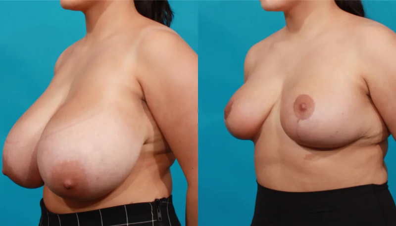 Пациентка пластического хирурга Гукаса Миракяна до и после операции по уменьшению размера груди