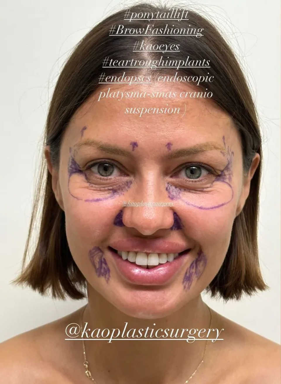 Виктория Боня. Разметка перед пластической операцией