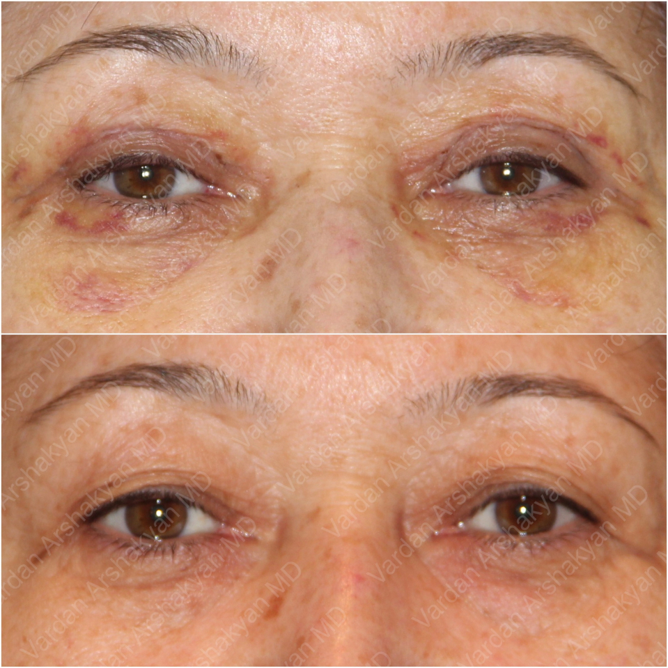 Пациентка пластического хирурга Вардана Аршакяна до и после блефаропластики