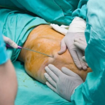 Что происходит во время липосакции?