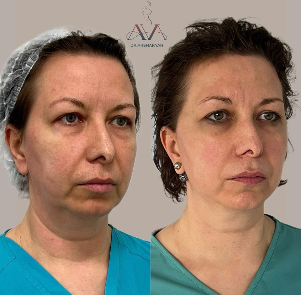 Пациентка пластического хирурга Вардана Аршакяна до и после омоложения лица нитями