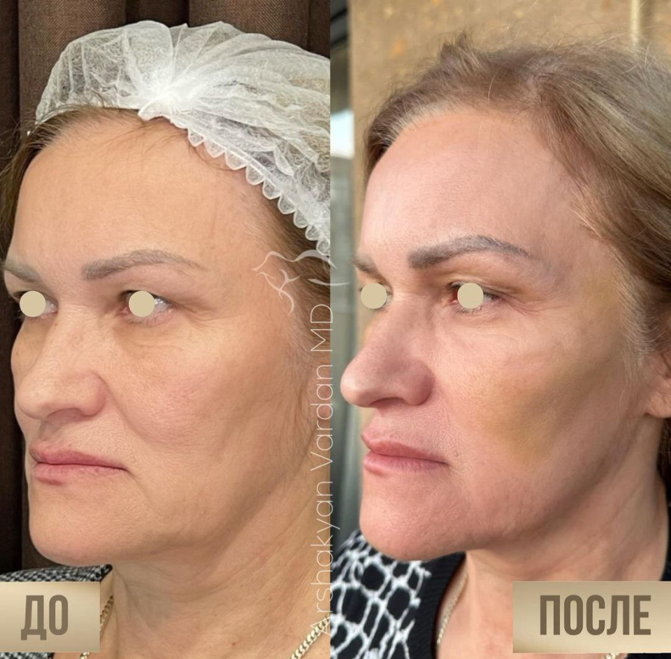 Пациентка пластического хирурга Вардана Аршакяна до и после нитевой подтяжки  лица