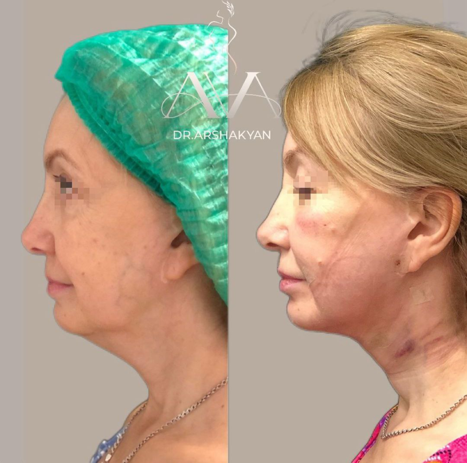 Пациентка пластического хирурга Вардана Аршакяна до и после удаления второго подбородка при помощи FaceTite