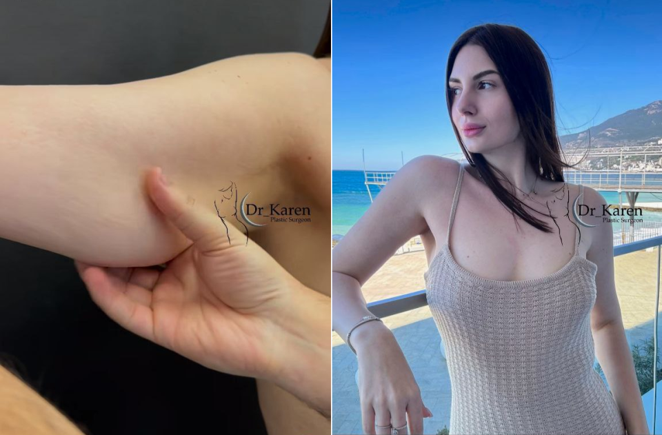 Пациентка доктора Карена Пайтяна. Одномоментная подтяжка и липосакция рук