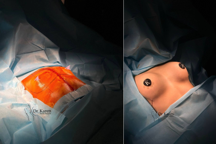 Пациентка хирурга Карена Пайтяна. Результат увеличения груди сразу после операции