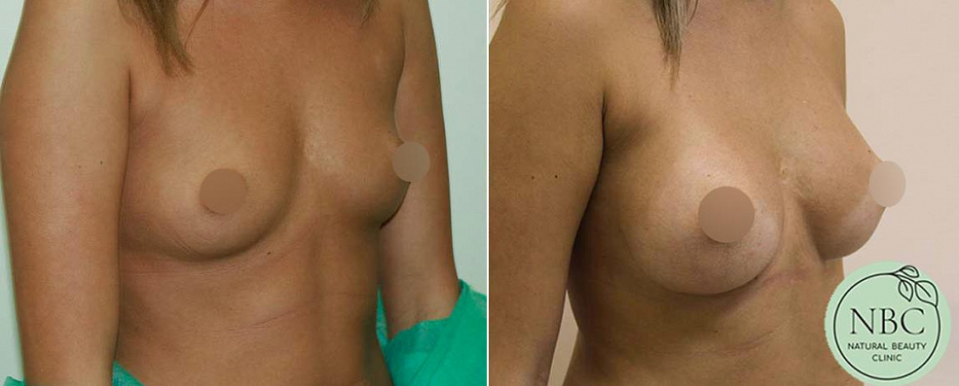 Фото до и после увеличения груди имплантами у хирурга Арслана Пенаева