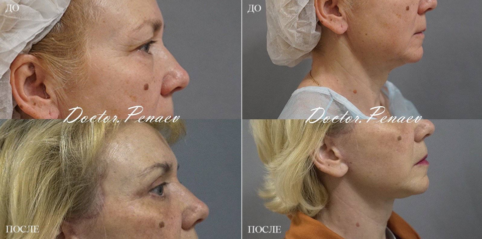 Пациентка (53 года) доктора Пенаева до и после подтяжки лица.