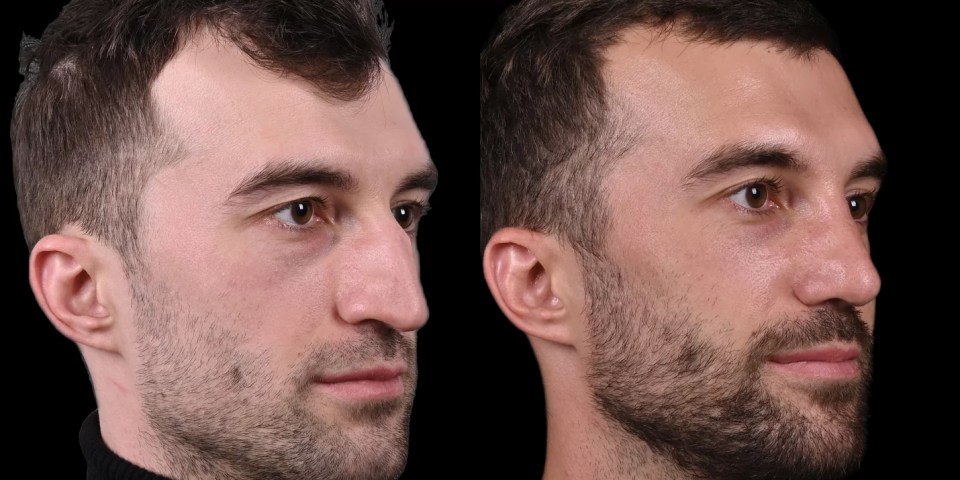 Пациент до и после ринопластики у доктора Давида Гришкяна