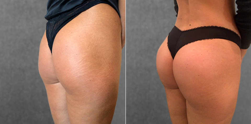 Пациентка Дмитрия Крысина до и после операции по увеличению ягодиц имплантами