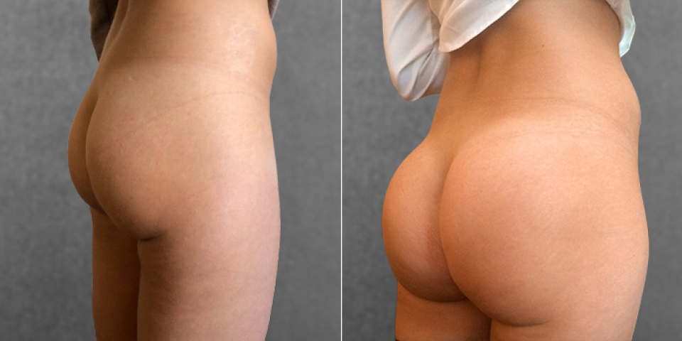 Пациентка хирурга Дмитрия Крысина до и после глютеопластики