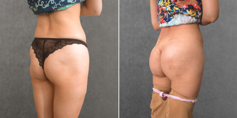 Пациентка доктора Дмитрия Крысина до и после глютеопластики