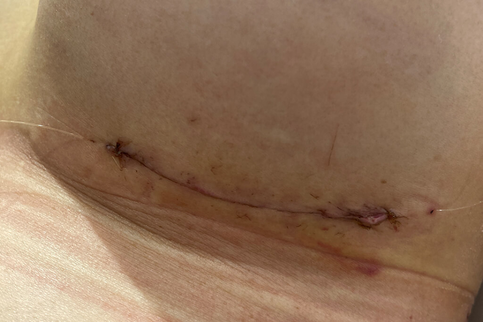 Рубец в первые дни после увеличения груди