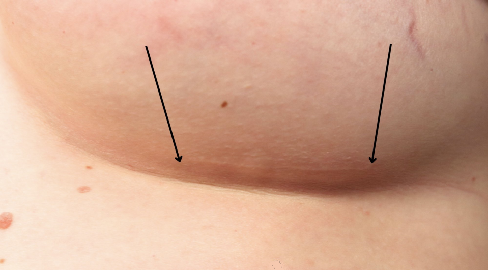 Заживший рубец после увеличения груди